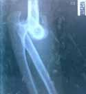 Elbow X-Ray